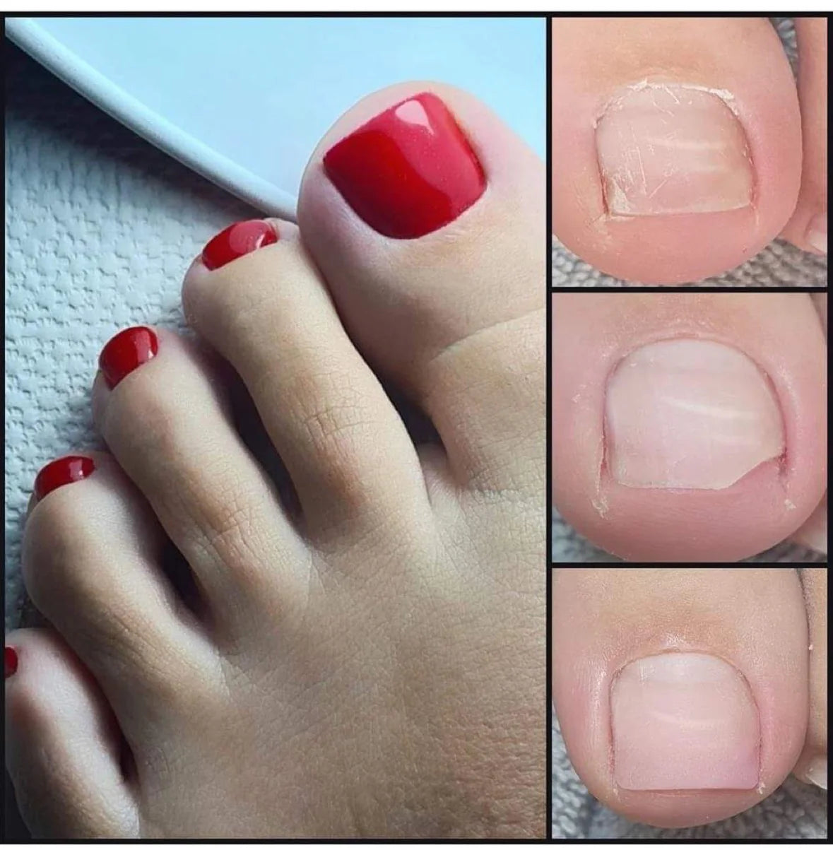 BrillBird Anti Fungus Pedi Shield Gel - Kentro Beauty Supplies Ireland